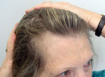 before hair restoration