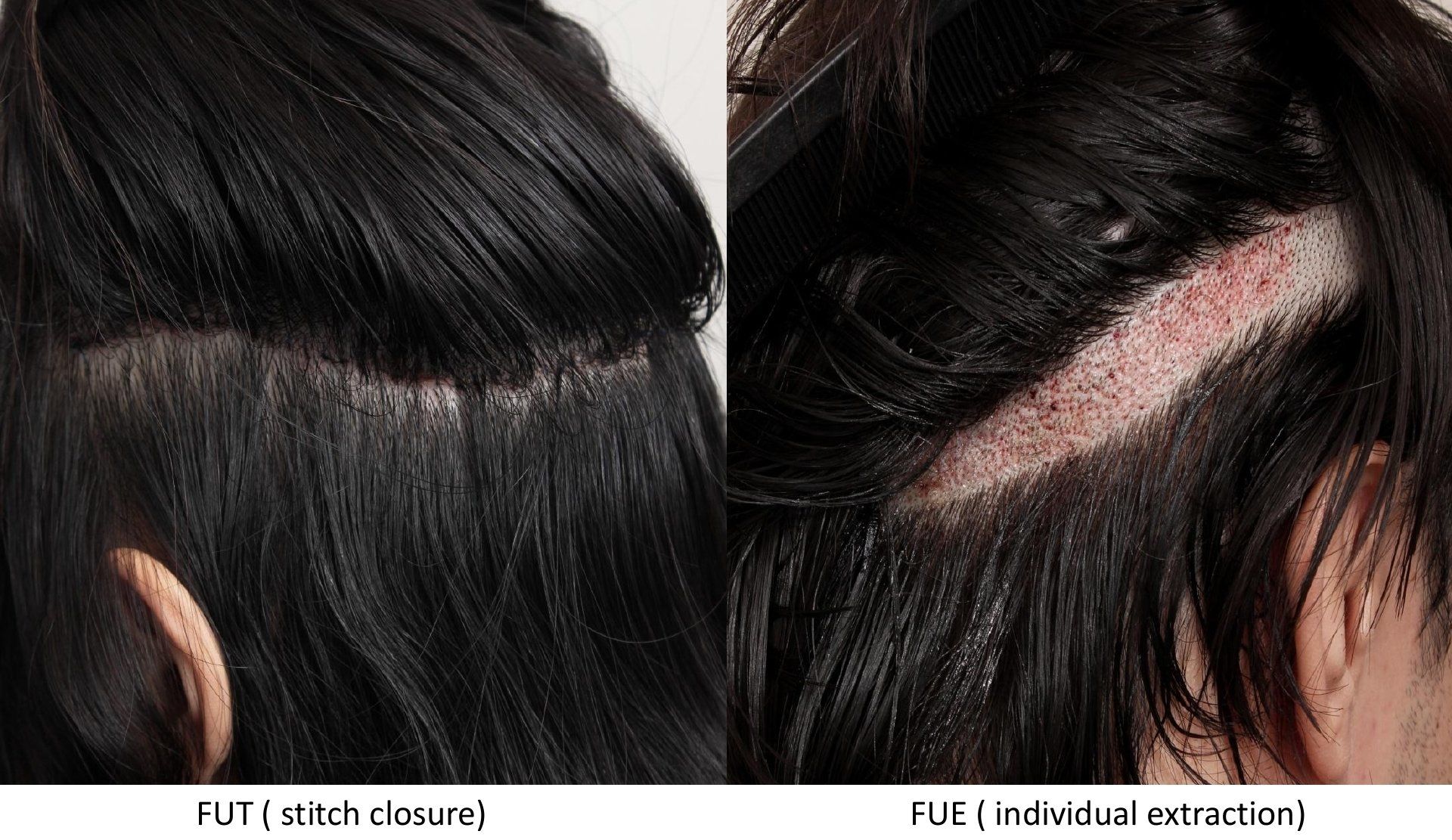 FUT vs. FUE images of scalp